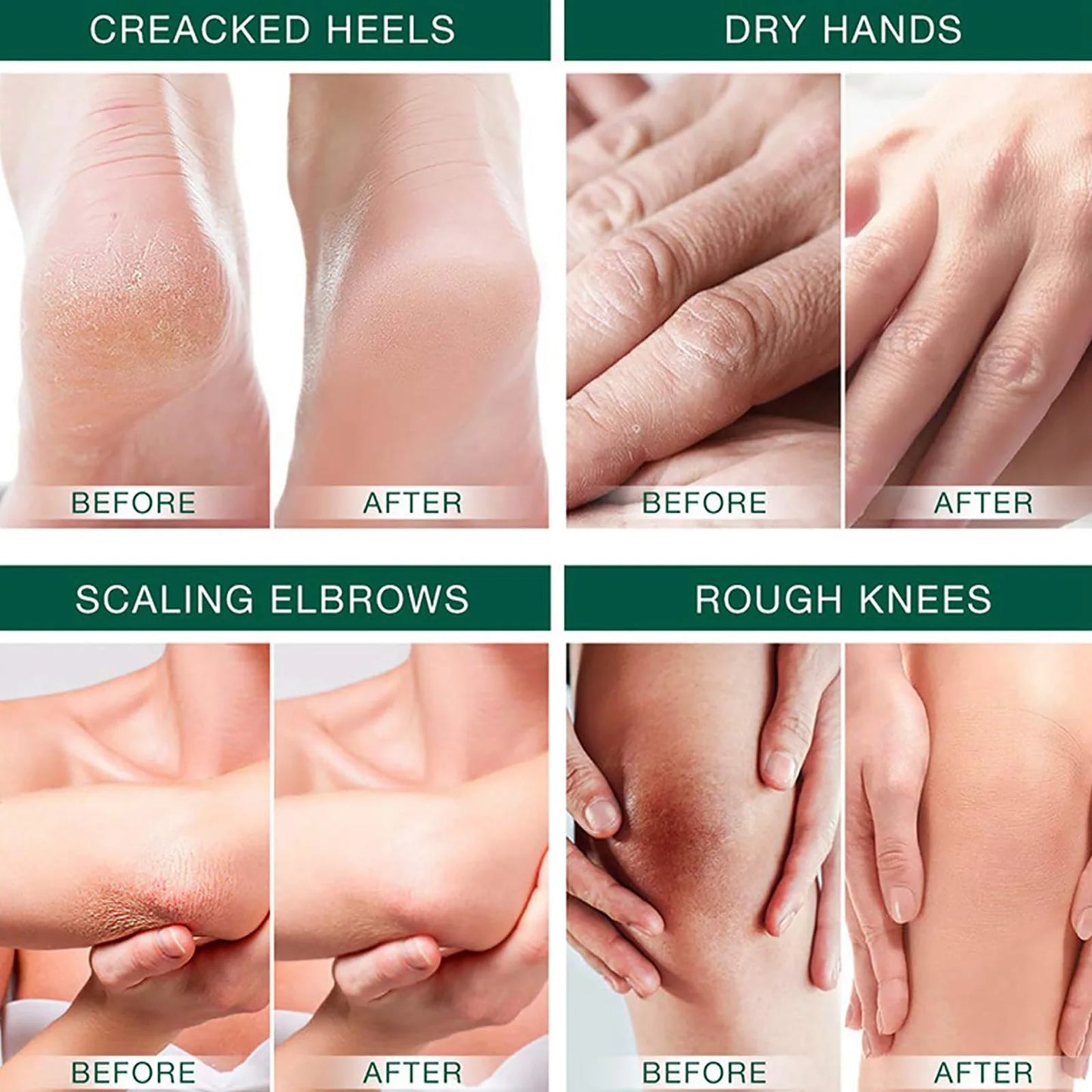 42% Urea Foot Cream for Dry, Cracked Heels