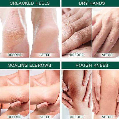 42% Urea Foot Cream for Dry, Cracked Heels